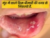 किस बीमारी की वजह से मुंह में निकलते हैं छाले? आजमाएं ये नुस्खा और छालों से हमेशा के लिए पाएं छुटकारा