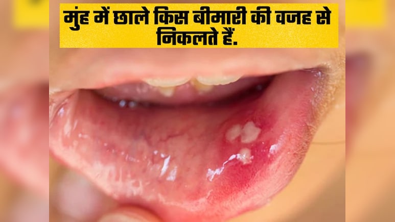 किस बीमारी की वजह से मुंह में निकलते हैं छाले? आजमाएं ये नुस्खा और छालों से हमेशा के लिए पाएं छुटकारा