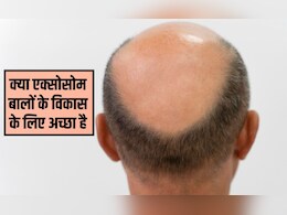 एक्सोसोम को बाल बढ़ने में कितना समय लगता है? एक्सोसोम हेयर ट्रीटमेंट कितने समय तक चलता है, जान&zwj;िए यहां