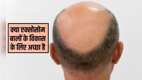 एक्सोसोम को बाल बढ़ने में कितना समय लगता है? एक्सोसोम हेयर ट्रीटमेंट कितने समय तक चलता है, जान&zwj;िए यहां