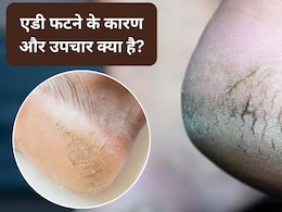 फटी एड़ियों में सिर्फ क्रीम न लगाइए, असली समस्या पहचानिए 7 कारण, 8 घरेलू उपचार