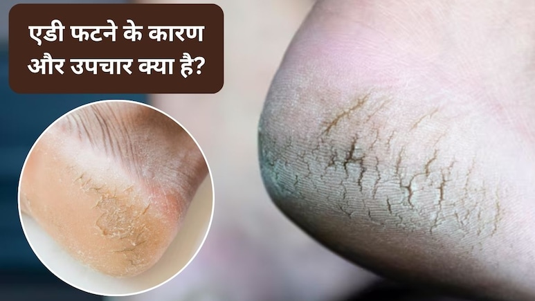 फटी एड़ियों में सिर्फ क्रीम न लगाइए, असली समस्या पहचानिए 7 कारण, 8 घरेलू उपचार