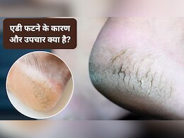 Cracked Heels: एड़ी फटने के लक्षण और उपचार क्या हैं? पैर फटने का मुख्य कारण क्या है, एक्सपर्ट से जानिए फटी एड़ी किस कमी से होती है