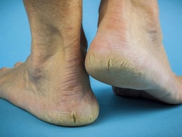 एड़ी में दर्द किस चीज की कमी से होता है? ये हो सकते हैं बड़े कारण