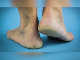 Home Remedies for Cracked Heels: डॉक्टर हंसा योगेन्द्र ने बताए फटी एड़ियों से छुटकारा पाने के सबसे असरदार नुस्खे