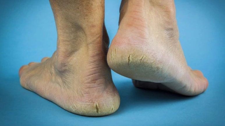 Home Remedies for Cracked Heels: डॉक्टर हंसा योगेन्द्र ने बताए फटी एड़ियों से छुटकारा पाने के सबसे असरदार नुस्खे