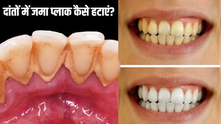 दांतों में जमा प्लाक कैसे हटाएं? डेंटिस्ट ने बताया पीली गंदगी साफ करने का सही तरीका