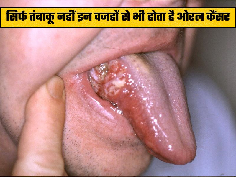21 साल के युवक को बिना तंबाकू के हुआ कैंसर, डॉक्टर ने बताया चौंकाने वाला कारण