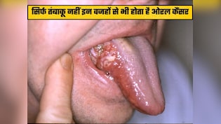 21 साल के युवक को बिना तंबाकू के हुआ कैंसर, डॉक्टर ने बताया चौंकाने वाला कारण