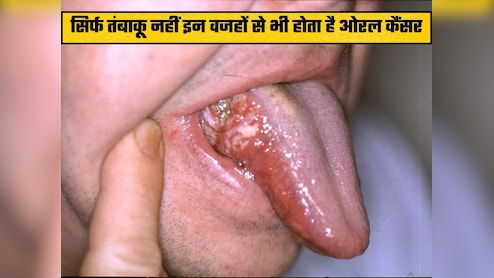 21 साल के युवक को बिना तंबाकू के हुआ कैंसर, डॉक्टर ने बताया चौंकाने वाला कारण