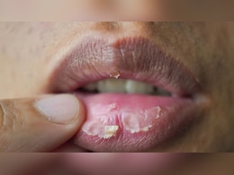 फटे होंठों में होती है जलन? होम्योपैथिक डॉक्टर ने बताया प्राचीन नुस्खा, एक हफ्ते में मुलायम हो जाएंगे लिप्स