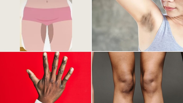 बिकनी एरिया, कोहनी, घुटने और अंडरआर्म्स की डार्क स्किन को कैसे साफ करें? डर्मेटोलॉजिस्ट ने बताया कैसे दूर होगी अलग-अलग हिस्सों की Pigmentation