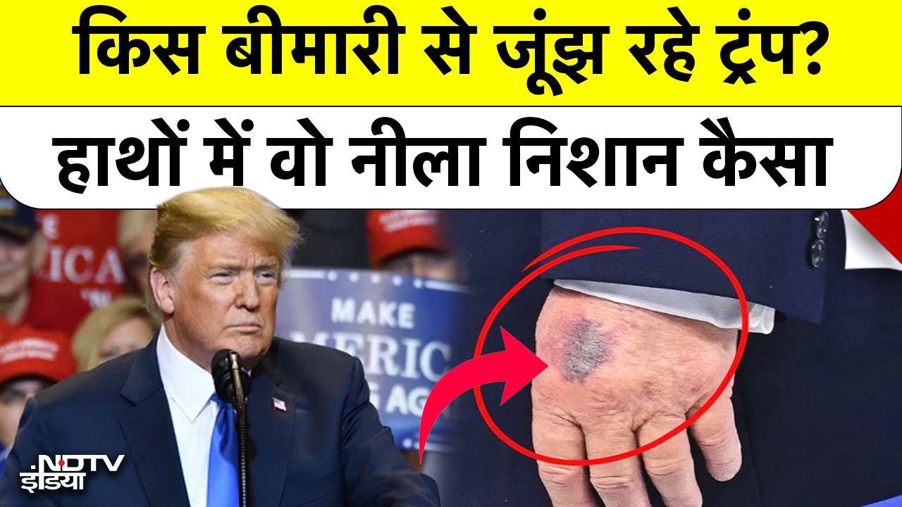 Donald Trump के हाथ क्यों पड़ गए नीले? क्या कोई गंभीर बीमारी है?