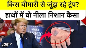 Donald Trump के हाथ क्यों पड़ गए नीले? क्या कोई गंभीर बीमारी है?