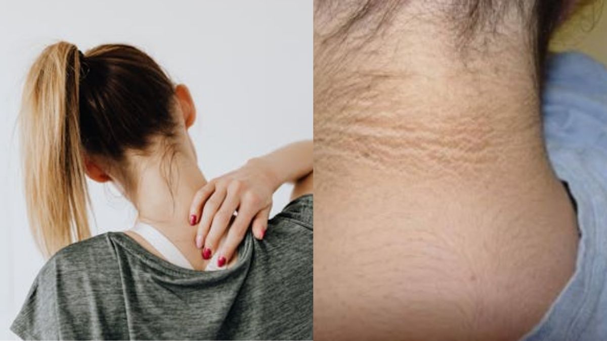 That Dark Patch On Your Neck Is Likely A Serious Health Warning, Explains Maharashtra Doctor
