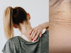 That Dark Patch On Your Neck Is Likely A Serious Health Warning, Explains Maharashtra Doctor