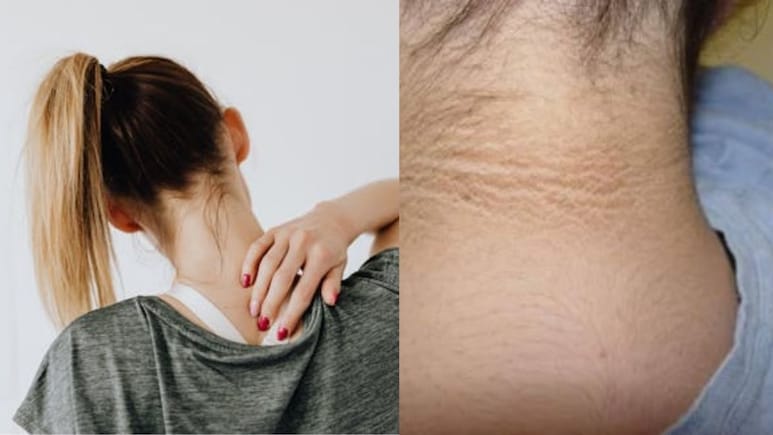 That Dark Patch On Your Neck Is Likely A Serious Health Warning, Explains Maharashtra Doctor