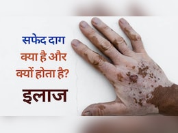 Explainer on Vitiligo: सफेद दाग क्यों होता है, सफेद दाग के शुरुआती लक्षण और उपचार | Vitiligo FAQs
