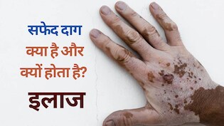 Explainer on Vitiligo: सफेद दाग क्यों होता है, सफेद दाग के शुरुआती लक्षण और उपचार | Vitiligo FAQs