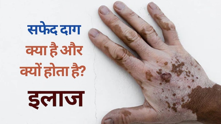 Explainer on Vitiligo: सफेद दाग क्यों होता है, सफेद दाग के शुरुआती लक्षण और उपचार | Vitiligo FAQs