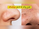 नाक के ब्लैकहेड्स को बिना पैसे खर्च किए हटाएं, डॉ हंसा योगन्द्र से जानें त्वचा के अंदर जमी गंदगी कैसे साफ करें