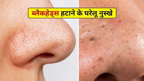 नाक के ब्लैकहेड्स को बिना पैसे खर्च किए हटाएं, त्वचा की अंदरूनी परत में जमी गंदगी कैसे साफ करें, डॉ. हंसा योगेन्द्र से जानिए