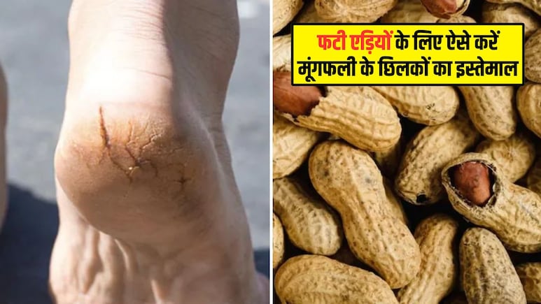 मूंगफली के छिलकों को फेंकिए मत, इस तरह करें फटी एड़ियों के लिए इस्तेमाल, मुलायम हो जाएगी त्वचा