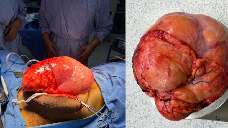 2 साल तक गैस समझी गई बीमारी निकली जानलेवा, 80 साल की महिला के पेट में था 10 किलो का ट्यूमर