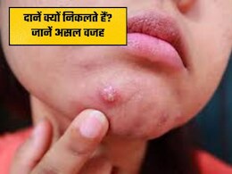 चेहरे पर क्यों निकलते हैं दाने और मुंहासे? जानिए इसका असली कारण और निजात पाने के उपाय