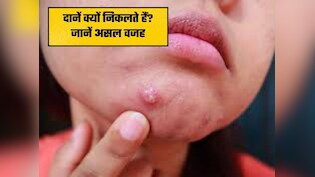 चेहरे पर क्यों निकलते हैं दाने और मुंहासे? जानिए इसका असली कारण और निजात पाने के उपाय