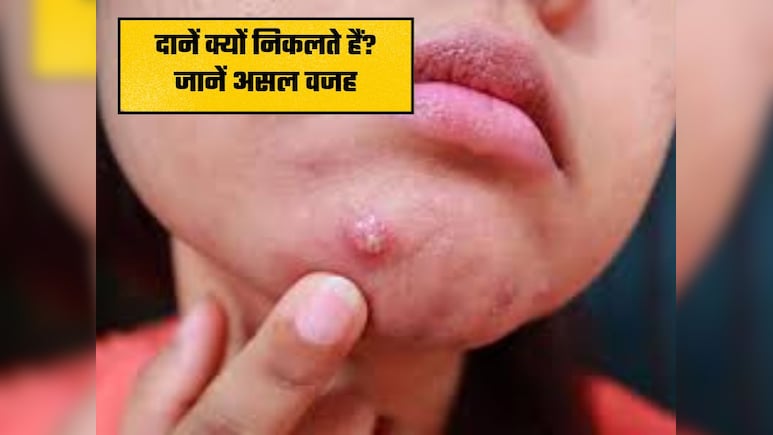 चेहरे पर क्यों निकलते हैं दाने और मुंहासे? जानिए इसका असली कारण और निजात पाने के उपाय
