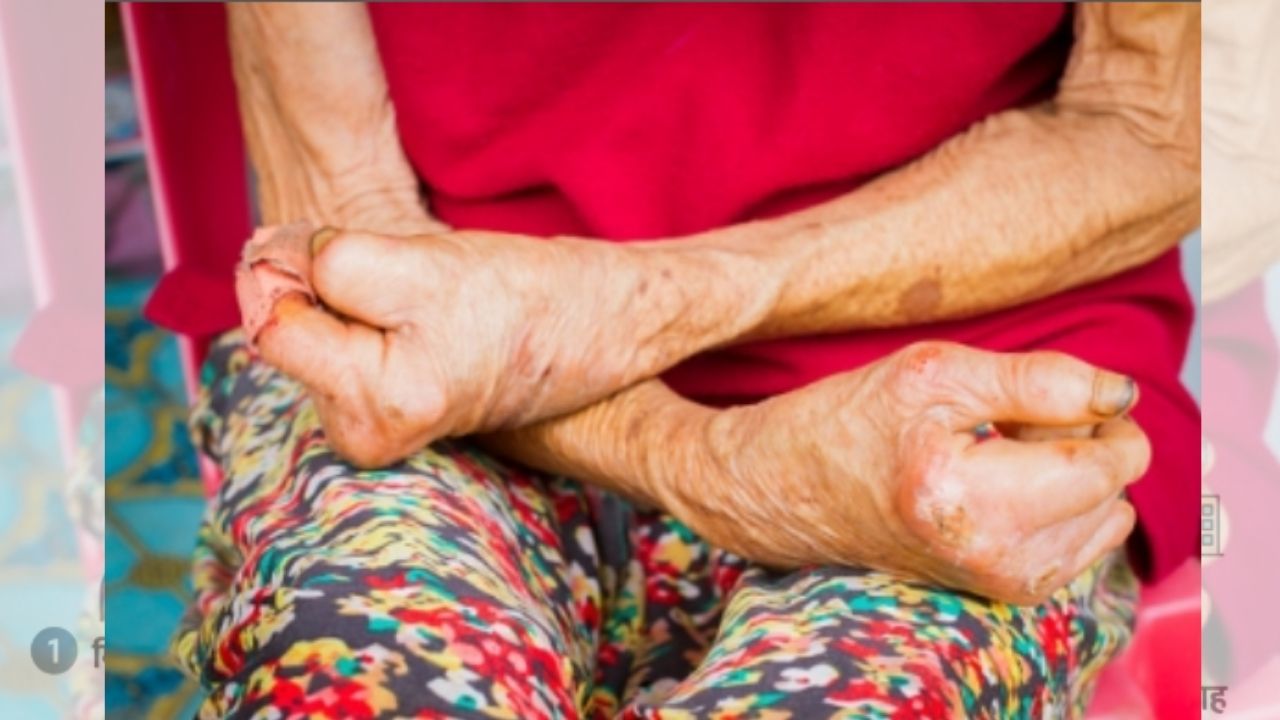 Leprosy-Free India Mission: Government To Ensure Free Screening And Treatment Nationwide