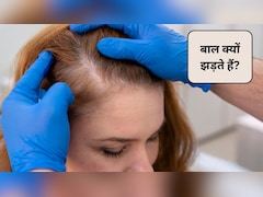 एलोपेसिया एरीटा बीमारी क्या होती है? क्या Alopecia Areata से ज्यादा बाल झड़ते हैं, इन 4 घरेलू उपाय से होगा बचाव