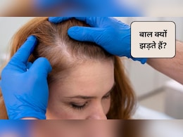 एलोपेसिया एरीटा बीमारी क्या होती है? क्या Alopecia Areata से ज्यादा बाल झड़ते हैं, इन 4 घरेलू उपाय से होगा बचाव