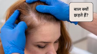 एलोपेसिया एरीटा बीमारी क्या होती है? क्या Alopecia Areata से ज्यादा बाल झड़ते हैं, इन 4 घरेलू उपाय से होगा बचाव