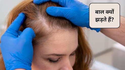 एलोपेसिया एरीटा बीमारी क्या होती है? क्या Alopecia Areata से ज्यादा बाल झड़ते हैं, इन 4 घरेलू उपाय से होगा बचाव