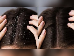 Home Remedies For Dandruff: डैंड्रफ या रूसी से छुटकारा दिलाते हैं ये घरेलू नुस्खे, एक्सपर्ट ने बताया कैसे करें उपयोग