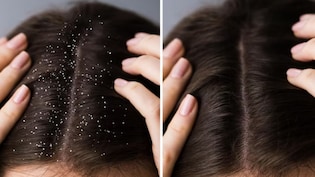 Home Remedies For Dandruff: डैंड्रफ या रूसी से छुटकारा दिलाते हैं ये घरेलू नुस्खे, एक्सपर्ट ने बताया कैसे करें उपयोग