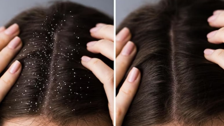 Home Remedies For Dandruff: डैंड्रफ या रूसी से छुटकारा दिलाते हैं ये घरेलू नुस्खे, एक्सपर्ट ने बताया कैसे करें उपयोग