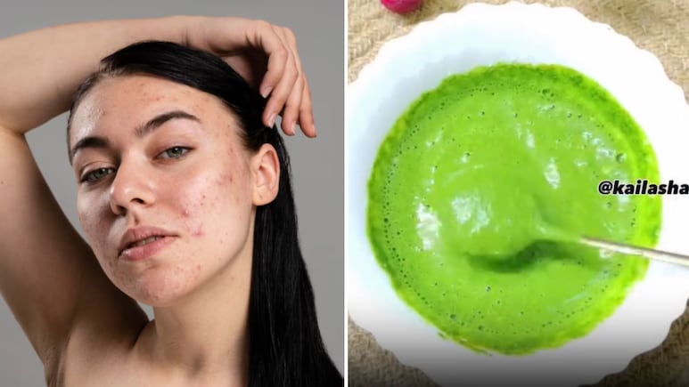 मुंहासे, डार्क स्पॉट्स और ओपन पोर्स से मिलेगा छुटकारा, नीम के पत्तों से बनाएं ये देसी फेस मास्क, योग गुरु कैलाश ने बताया तरीका