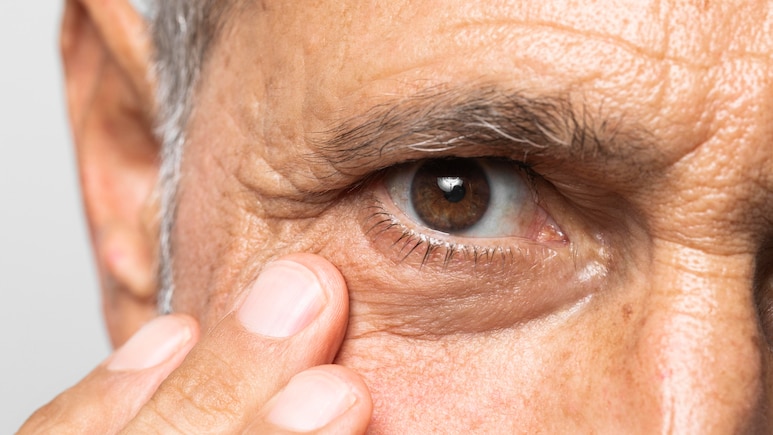 Can You Have Eye Disease Without Symptoms? Understanding Glaucoma