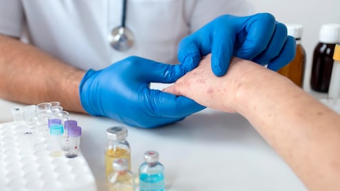 Measles Is Back: Why Outbreaks Are Rising Across The World Again