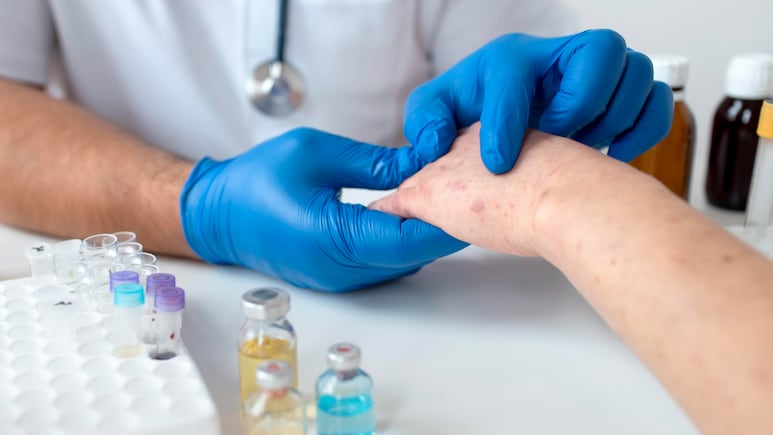 Measles Is Back: Why Outbreaks Are Rising Across The World Again