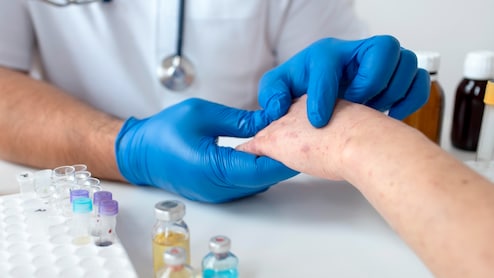 Bangladesh Measles Crisis Is a Warning India Cannot Ignore