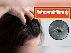 सिर से एक-एक जूं को खत्म कर देंगे ये 2 उपाय, बालों में चिपकी लीख भी हो जाएंगी साफ, बस जान लें क्या करें