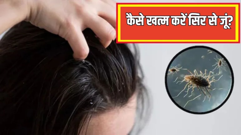 सिर से एक-एक जूं को खत्म कर देंगे ये 2 उपाय, बालों में चिपकी लीख भी हो जाएंगी साफ, बस जान लें क्या करें