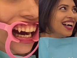 Temporary Vampire Teeth: दुबई की लकड़ी ने लगवाए Vampire Teeth, क्यों ऐसा कर रहे हैं लोग, क्या है ये नया शौक