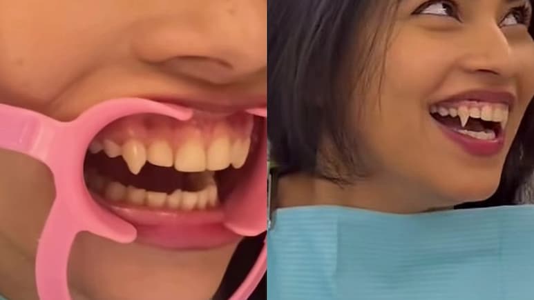 Temporary Vampire Teeth: दुबई की लकड़ी ने लगवाए Vampire Teeth, क्यों ऐसा कर रहे हैं लोग, क्या है ये नया शौक