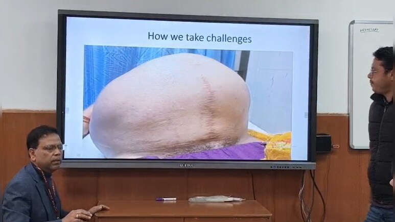 दिल्ली AIIMS का चमत्कार! डॉक्टर्स ने कैंसर से जूझ रही महिला के पेट से निकाला 19.9 किलो का ट्यूमर