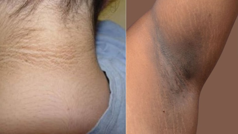 That Dark Patch On Your Neck Is Likely A Serious Health Warning, Explains Maharashtra Doctor